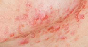 赤ニキビはアクネ菌が繁殖して皮膚が炎症を起こした状態です。